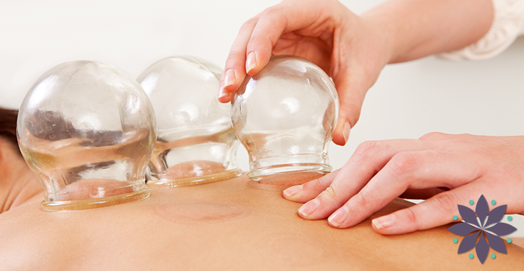 Cupping Therapy in Annapolis Maryland