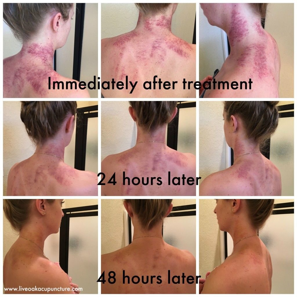 Does Gua Sha Work? Health Benefits Of Skin Scraping Therapy